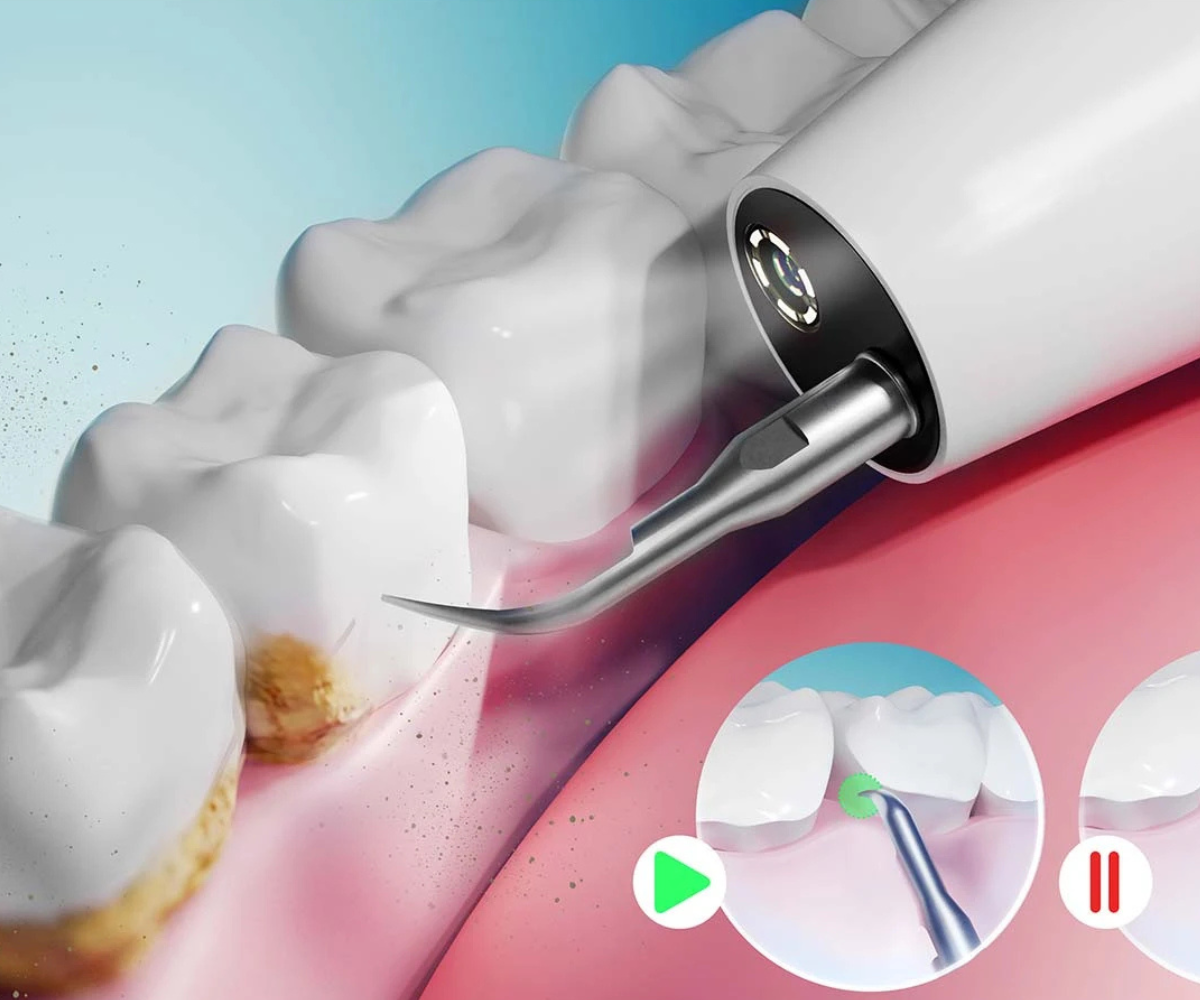 Veekindel Berdsen BD-250 hambakivi eemaldaja kaamera, taimeri ja LED-valgusega